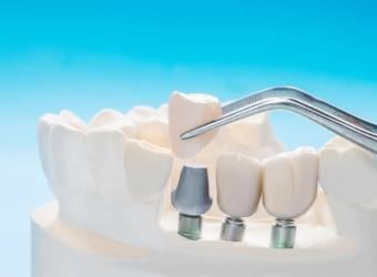 All About Dental Implants