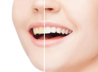 Brighten Your Smile with Professional Teeth Whitening